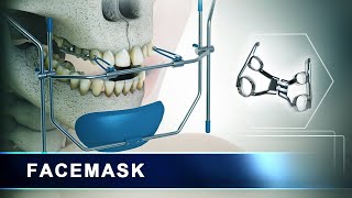 Facemask  Orthodontic Headgear Appliance  3d Animation [upl. by Nikolia]