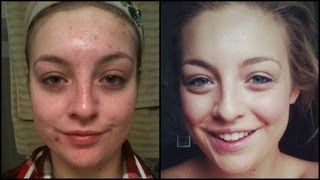 Accutane FAQ Side Effects [upl. by Ahsiuqram]