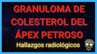 GRANULOMA DE COLESTEROL del ÁPEX PETROSO 💀en tomografía y RM [upl. by Aerdnu466]