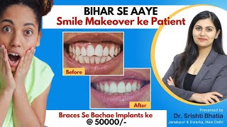 Smile Makeover for Patient from Bihar Dr Srishti Bhatia smilemakeover smile [upl. by Eserahc820]