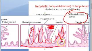 Pathology 521 g Neoplastic polyp tubular adenomatous villous papilloma tubulovillous papillary [upl. by Haze]