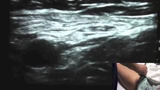 Ultrasound Guided Femoral Nerve Block  SSRAUSAcom [upl. by Waite]