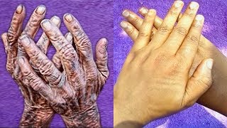 HOW I REMOVE WRINKLES ON MY HANDS amp FINGER  CLEAR HAND ROUGHNESS AND DRYNESS [upl. by Best572]