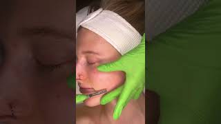 ASMR Mesmerizing Dermaplaning Treatment [upl. by Anirdna]