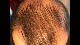 14 month’s using minoxidil  Rogaine 5 Before amp After results [upl. by Kcirddet]