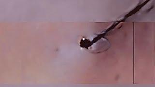 Removal of ingrown hair [upl. by Figone]