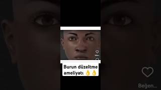 Burun düzeltme ameliyatı 👌burun estetik burunameliyatı burunameliyati sağlık estetikburun [upl. by Alamak]