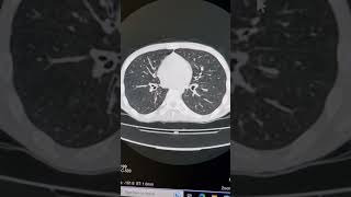 Alveolitis bronchiolitis and mild bronchiectasis [upl. by Ecyla395]