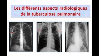 interprétation des clichés thoraciques tuberculosepulmonaire partie 1 [upl. by Akinom]