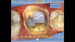 CEREC Single Posterior Crown Design [upl. by Cavanagh39]