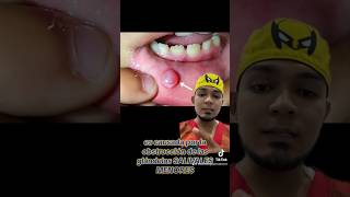 MUCOCELE 👨‍🏫ya lo sabías❓ greenscreen odontologo viralshorts colombia [upl. by Marv]