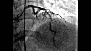 Corazón cateterismo stent [upl. by Brett]