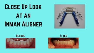 What is an Inman Aligner [upl. by Ruder828]