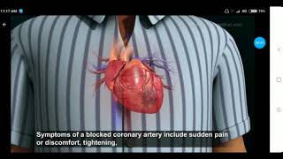 Myocardial Infarction in Hindi Part 2 by Dr Maulik Patel [upl. by Waiter]