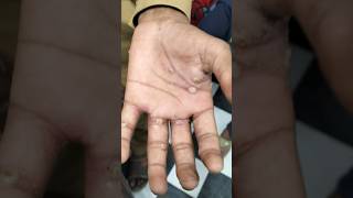 Example of scabies  Sarcoptes scabiei scabies scabiestreatment scabiespadakucing medical viral [upl. by Smukler576]