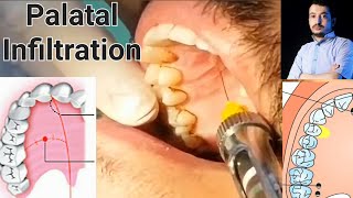 Local Anesthesia Palatal Infiltration Technique Maxillary Anesthesia Techniques dentistry [upl. by Acinhoj437]