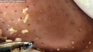 No misses Video of tweezers used to remove blackheads that leave craterlike holes 3時間ピンセット角栓取り動画 [upl. by Enitsirt590]