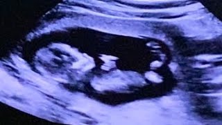 NT Scan at 13 Weeks Pregnancy  Nuchal Translucency Scan 1114 Weeks Pregnancy [upl. by Ehudd]