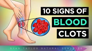 Top 10 Warning Signs of BLOOD CLOTS [upl. by Nnanaej919]