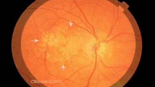 Macular Degeneration and the Aging Retina [upl. by Sapphira]