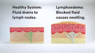 Managing Lymphoedema with Compression Therapy [upl. by Eelarbed]