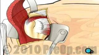 Rotator Cuff Repair Open Surgery [upl. by Nahshu786]