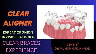 SHARING CLEAR ALIGNER EXPERIENCE AT ODONTOLOGY INN BY DR MUHAMMAD AHMAD IN CONFERENCE [upl. by Duke435]