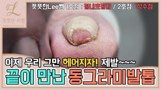 ENG SUB끝이 만난 동그라미발톱 이제 그만 헤어지자 ingrown toenail  ingrowing nail  Fresh Foot 풋풋한리쌤 성수점  평내호평점 [upl. by Nonnahsal]