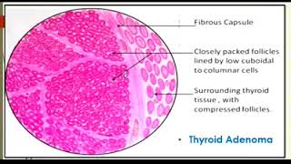 Thyroid Adenoma Thyroid Carcinoma General Pathology Practical  Learning Pathology [upl. by Hpejsoj123]