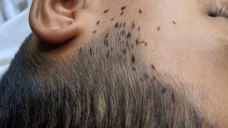 How to get rid hundred lice from short hair  Remove all big lice from black hair [upl. by Bumgardner26]