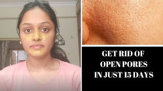 How to Get Rid of Large OPEN PORES Permanently In Telugu  Heavenly Homemade [upl. by Belshin]