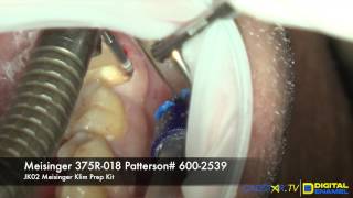 The Subgingival Margin with the CEREC Omnicam [upl. by Nilatak]