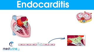 Endocarditis  causes symptoms pathophysiology diagnosis and treatment [upl. by Ettegroeg354]