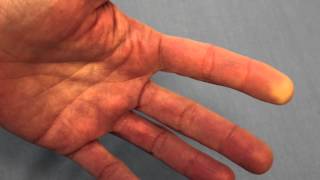 Raynauds Phenomenon Reduced Blood Flow of the FIngertip [upl. by Aihsad]