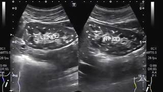 Ultrasound Video showing bilateral renal microlithiasis [upl. by Niad196]