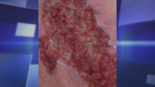 Pyoderma Gangrenosum – Could It Happen To You [upl. by Hsan]