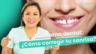 Diastema dental Como corregir tu sonrisa [upl. by Nerreg]