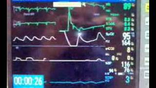 DC Cardioversion of SVT [upl. by Rudiger]