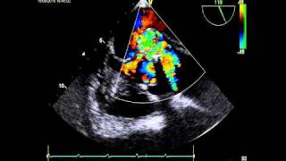 AORTIC DISSECTION ECHOCARDIOGRAPHY [upl. by Idieh32]