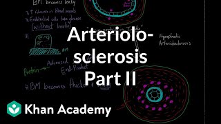 Arteriolosclerosis  part 2  Circulatory system diseases  Health amp Medicine  Khan Academy [upl. by Leugimesoj]