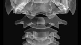 Odontoid Positioning tutorial [upl. by Orfurd]