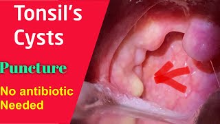 Tonsil Cyst White thing over tonsil Symptoms and management No antibiotics needed [upl. by Hairem825]