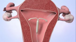 Patient Education Video Intrauterine Device IUD [upl. by Poland]