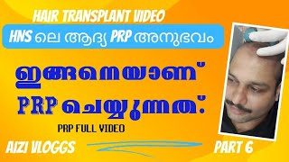 HAIR TRANSPLANT IN MALAYALAM at low cost PRP അനുഭവം HNS COIMBATORE [upl. by Matthaus]