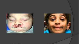 Before amp After Cleft Lip and Palate Surgery performed by Dr Fernando Burstein [upl. by Luckett864]