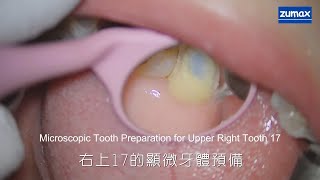 The case of Microscopic Tooth Preparation for Upper Right Tooth 17 by Dr Kuotsai Hsu [upl. by Narat]