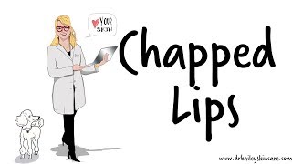 CHAPPED LIPS  Causes and REMEDIES for cracked lips [upl. by Kay]