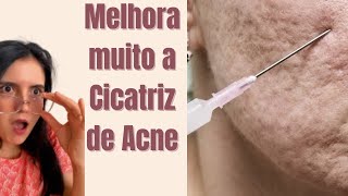 4 Tratamentos eficazes para CICATRIZ DE ACNE [upl. by Adlesirk]