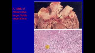 pathology  dr dhaymaa  Cardiomyopathy amp Endocardiatis [upl. by Kimbra55]