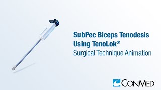 SubPec Biceps Tenodesis Using TenoLok®  CONMED Animation [upl. by Sandi403]